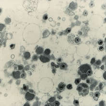 Magnified 49, 200x, this transmission electron micrograph (TEM) depicts numbers of cytomegalovirus virions that were present in an unknown tissue sample. Cytomegalovirus (CMV) is one of the herpesviruses. This group of viruses includes the herpes simplex viruses (HSV), varicella-zoster virus (VZV), which causes chickenpox and shingles, and Epstein-Barr virus (EBV), which causes infectious mononucleosis, also known as mono.  Photo credit: Centers for Disease Control and Prevention